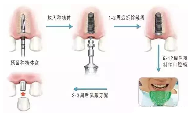 刘教授右上3颗大牙脱落后戴活动假牙多年,但一直被咀嚼无力,磨牙床等